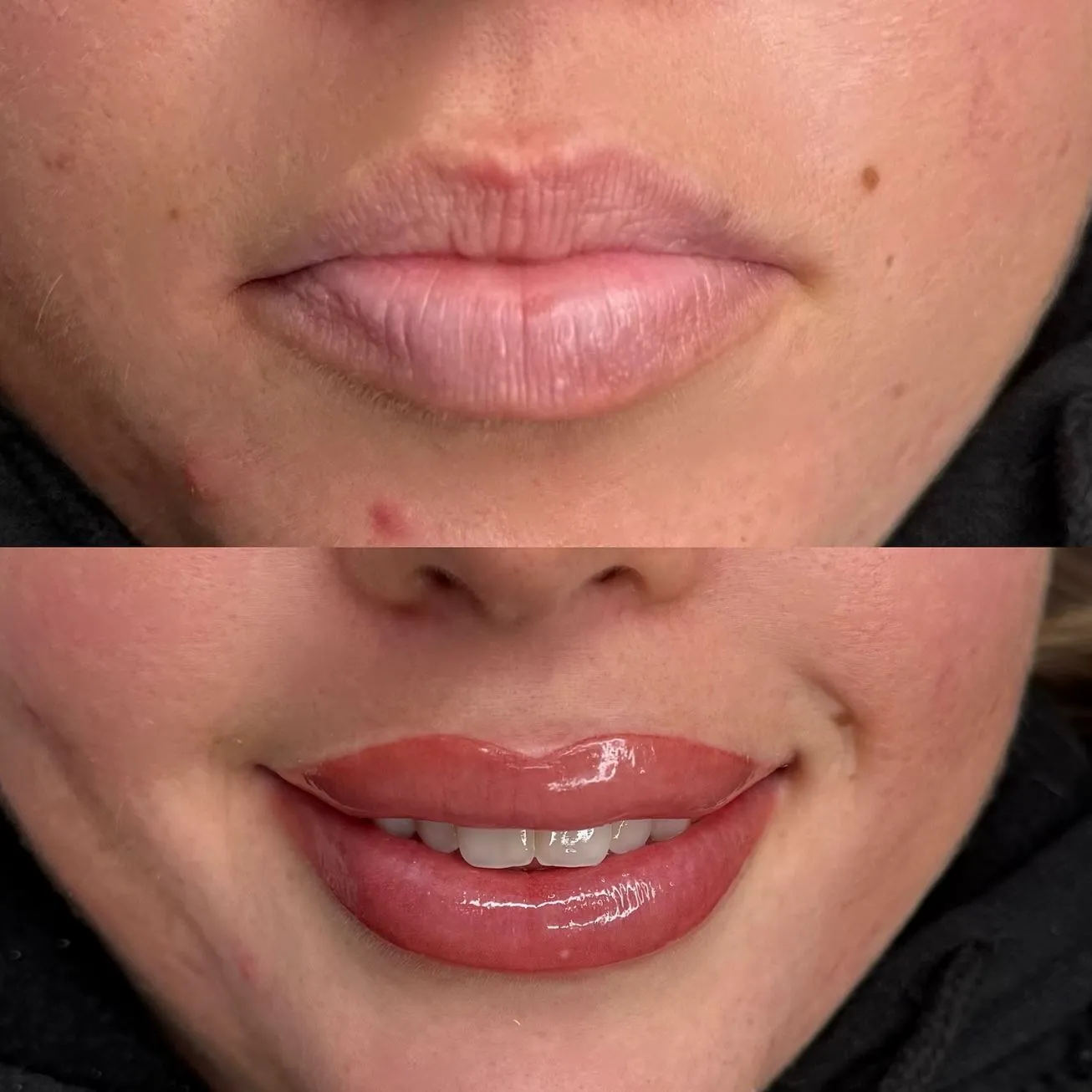 Purikelapa | Who Should Avoid Lip Blushing? Blood Thinners & Medications