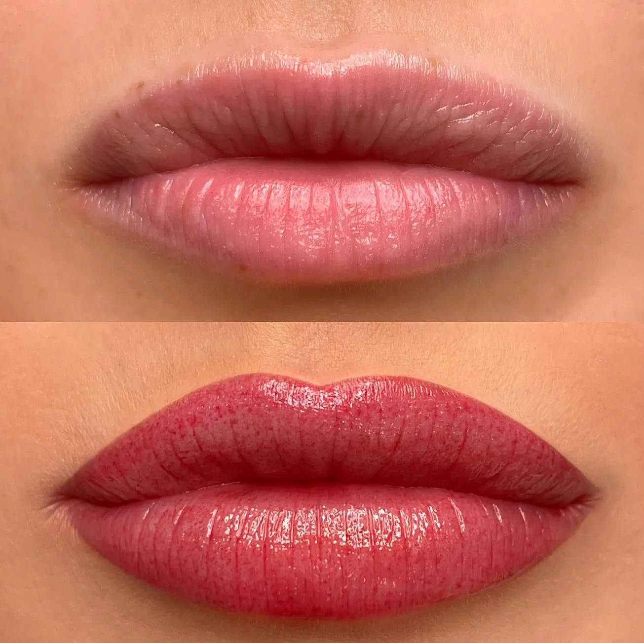 Lip Tattoo Removal and Corrections