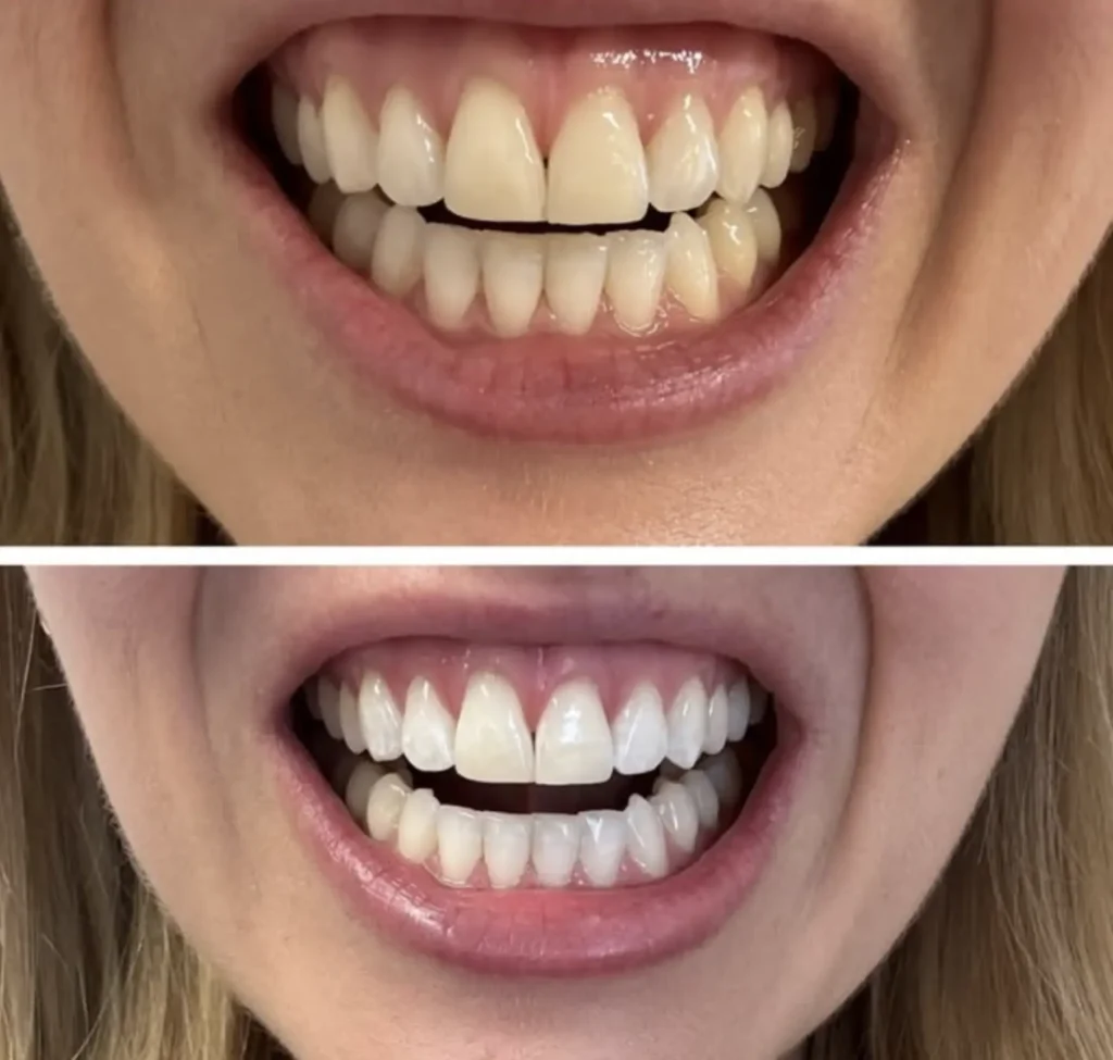 Teeth whitening Brisbane