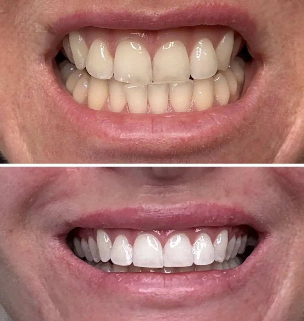 Purikelapa | Why Do Teeth Look More Yellow After Whitening?