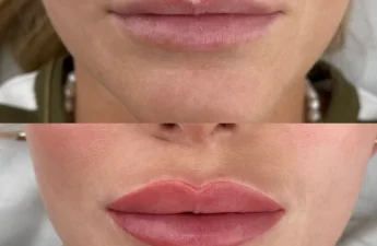 Who Should Avoid Lip Blushing