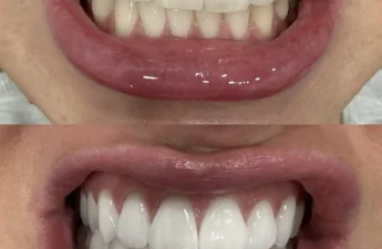 Why Do Teeth Look More Yellow After Whitening